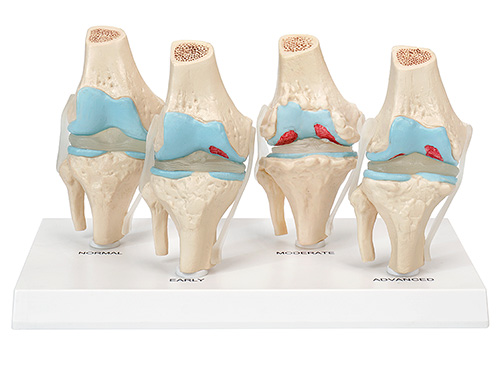 膝关节健康病态比较模型