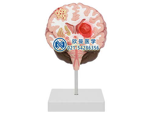 脑中风模型(大脑疾病模型)