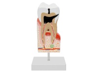 磨牙病理模型